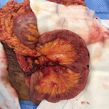 Post mesenteric repair, bowel resection anastomosis.