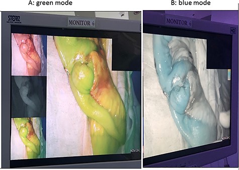 ICG study for bowel ischemia, showed no ischemia with good perfusion.