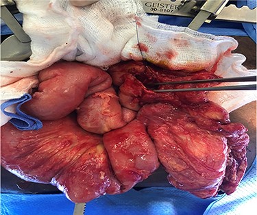Ascending colon large perforation.