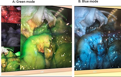 Post ileocolic anastomosis, good perfusion.