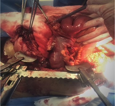 Avulsed greater omentum with large right colon mesenteric laceration and avulsion.