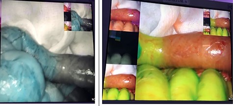 Post extended right hemicolectomy vascularity assessment.
