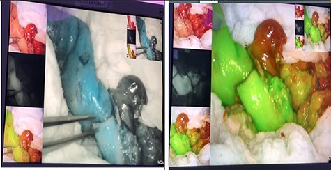Post anastomotic ICG perfusion assessment.