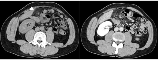 Abdominal CT images: nodular mass and high-density lesions in the fat tissue near the hepatic flexure of the ascending colon are evident (white arrow).