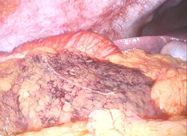 Ischaemic change is noted in the part of greater omentum that is adherent to the ascending colon near the hepatic flexure.