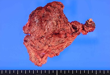 Macroscopic findings: the 10 cm × 7 cm-sized specimen is twisted and dark red in colour.