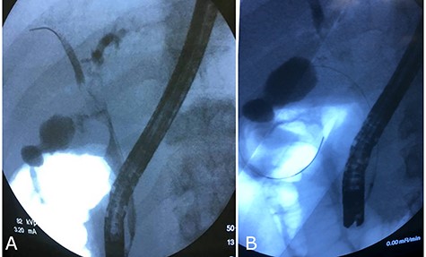 Cholangiography first ERCP. (A) Ab extrinsic compression of CBD; (B) tardive opacization of gallbladder showing fistula with colon.