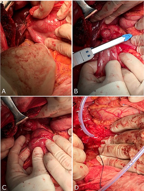 Surgical treatment through a laparotomy. (A) Fistula between gallbladder and colon; (B and C) wedge resection of colon with fistula; (D) insertion of ‘Kehr’s T-tube’ into CBD.