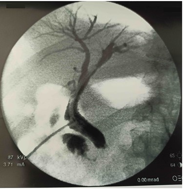 Trans-Kehr cholangiography.