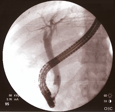 Cholangiography after biliary stent removal.