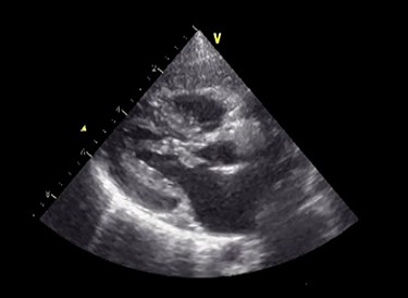 Preoperative echocardiography. The abnormal muscle band in left ventricle and severe SAM of the mitral valve are observed. The anterior leaflet of mitral valve obstructs the LVOT in the systolic phase.
