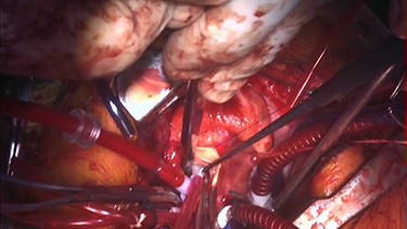 Intraoperative findings. The abnormal muscle band is cut by scalpel, and edge-to-edge repair of the mitral valve is performed.