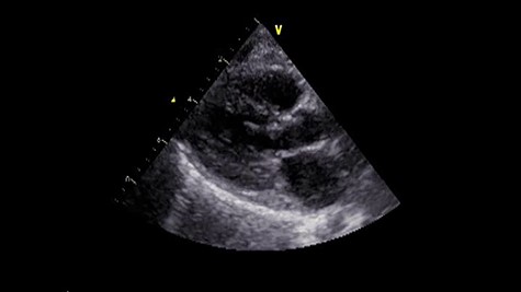 Postoperative echocardiography. The abnormal muscle band has disappeared, and the SAM of mitral valve is well controlled.