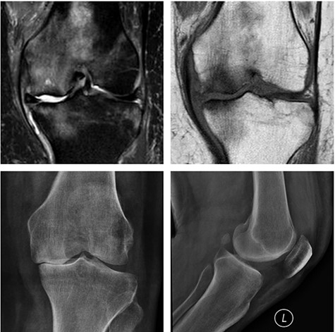 Left knee T2 coronal MRI (top left) showing MP and femoral condyle SIFK with articular failure of both surfaces; Top right: same image (T1); Bottom left: orthostatic anterior view X-ray image of the same patient showing medial compartment bone-on-bone contact; Bottom right: lateral view X-ray image of the same patient.