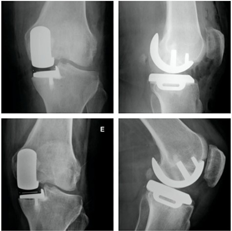 Top: anterior (left) and lateral view (right) X-ray images of the immediate postoperative period (medial UKA); Bottom: anterior (left) and lateral view (right) X-ray images of the same patient with 5 months of follow-up with tibial component loosening.
