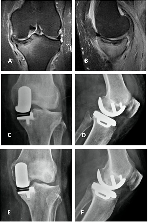 Coronal (A) and sagittal (B) T2 MRI—left knee—showing severe MP SIFK; Anterior (C) and lateral view (D) X-ray images of immediate postoperative period (medial UKA); Anterior (E) and lateral view (F) X-ray images with 3 months of follow-up with tibial component loosening.