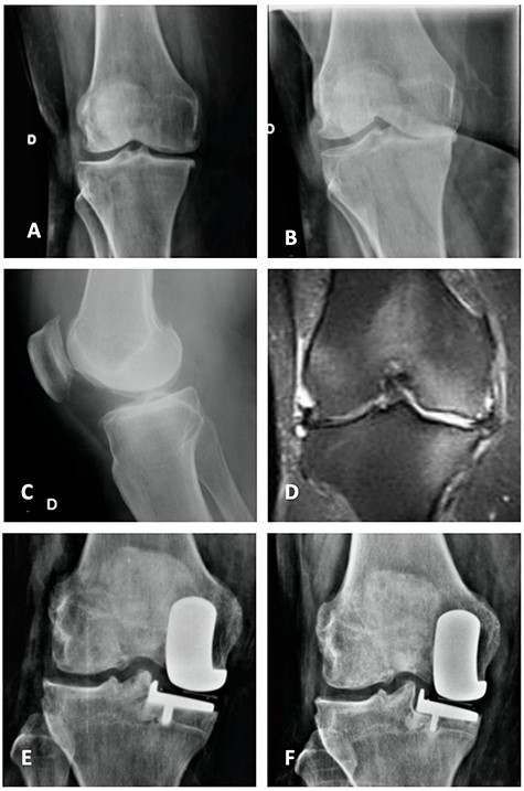Orthostatic anterior view (A) and Rosenberg (B) X-ray images with medial osteoarthritis—right knee; Lateral view X-ray image of the same knee (C); T2 coronal MRI (D) with severe MP and femoral condyle SIFK; Immediate postoperative X-ray image (E) and 3 months after surgery (F) showing tibial component loosening.
