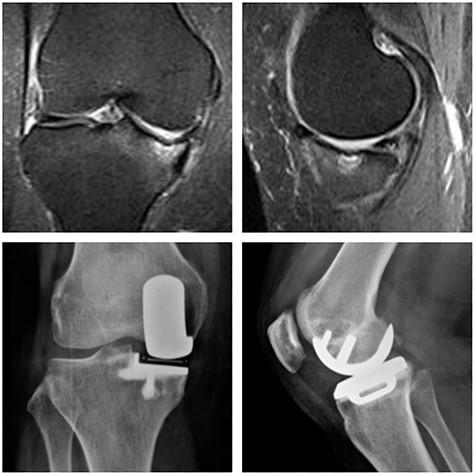 Top: coronal (left) and sagittal (right) T2 MRI with MP SIFK and a mild articular irregularity; Bottom: anterior (left) and lateral view (right) X-ray images 2 years after surgery with good clinical and functional results.