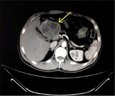 Axial contrast-enhanced CT scan of the abdomen demonstrating a well-defined solitary cystic lesion in the head of the pancreas with a diameter of (9 cm).