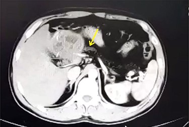 Axial contrast-enhanced CT scan of the abdomen showing dilatation of the MPD (5 mm).