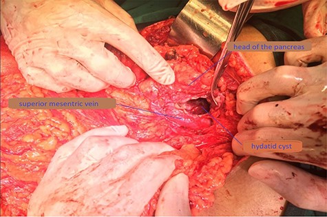 Operative photograph demonstrating the location of the unroofed cyst in the pancreatic head near the superior mesenteric vein.