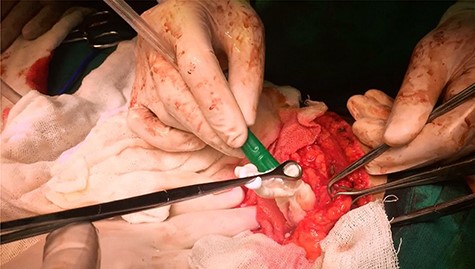 Operative photograph demonstrating the extraction of the germinative membrane.