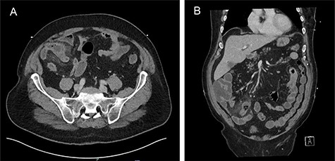 (A) Axial and (B) coronal views: acute Meckel’s diverticulitis in RIF associated with extensive adjacent mesenteric stranding.