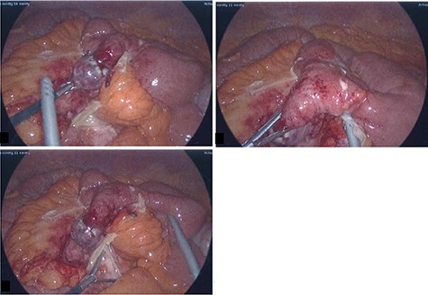 Intra-operative photos: acutely inflamed MD with a wide base and gangrenous tip, associated with significant surrounding inflammation.