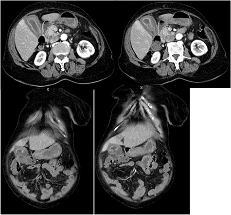 CT axial and coronal images of the abdomen showing diffuse thickening of the gall bladder with pericholecystic fluid collection; gallbladder perforation and fluid collection around the transverse colon (hepatic flexure) suggestive of contained perforated acalculuscholecytitis.