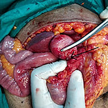 Concealed perforation at the fundus (arrow) pulling the epiploic appendages of the transverse colon.