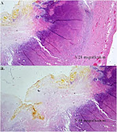 Photomicroscopy of gallbladder tissue demonstrating chronic cholecystitis characterized by wall thickening, edema and necrotizing inflammation secondary to perforation; H&E staining ×20 original magnification (A); and ×40 original magnification (B).