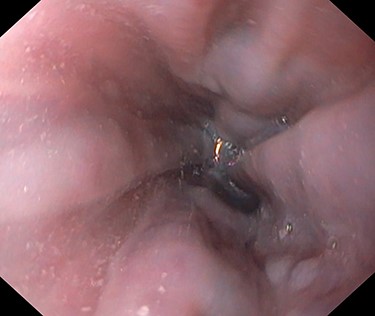 Cesophageal varices 4 months before the LRYGB operation.