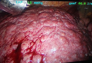 Thick, round-shaped and cirrhotic liver in a patient accepted to LRYGB operation (photographed during the operation by Pirjo Käkelä).