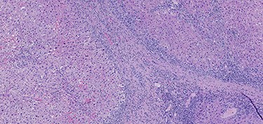 Hematoxylin and eosin stain (H & E) sections of hepatitis (100×).