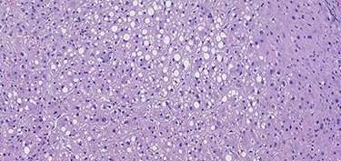 H & E sections of mild steatosis (200×).
