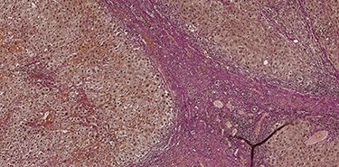 Van Gieson's stain (VG) sections of micronodular cirrhosis (100×).