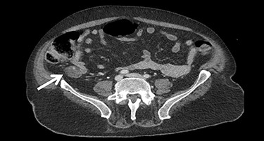 Suspected tumor mass.