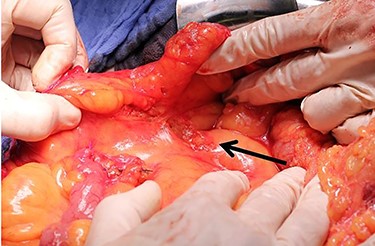 Right lower quadrant with hole in mesocolon.