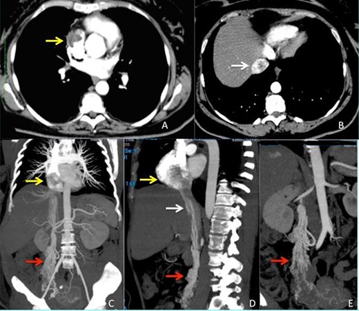 CT scan images (A–B) arterious phase showing the defect inside right atrium (yellow arrow) and intrahepatic inferior vena cava (white arrow) due to the presence of the intravascular leimyoma. (C–D) vascular CT reconstruction of the ovarian veins (red arrow), inferior vena cava (white arrow) and right atrium (yellow arrow) stored with the intravascular leiomyoma. (E) Particular view of the ovarian veins (red arrow) with the origin from the right uterine aspect.