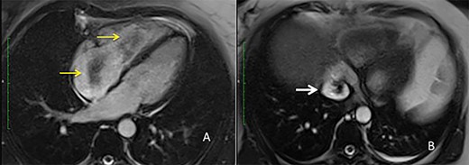 MRI view (A) right atrium with the intravascular leiomyoma prolapsing into the right ventricle (yellow arrow) (B) intrahepatic inferior vena cava stored with the intravascular leiomyoma (white arrow).