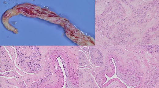 The surgical and pathological aspect of the extracted specimen.
