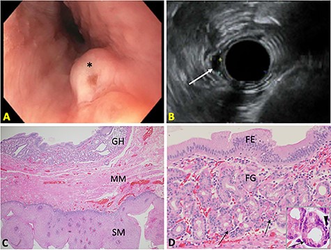 (A) Endoscopic image of the esophageal nodule (*). (B) Endosonographic image showing a hypoechoic, oval subepithelial lesion (arrow). (C) Submucosal heterotopic GH beneath the MM of esophageal SM (H&E 20X). (D) Superficial foveolar epithelium (FE) and deep fundic glands (FG) with parietal cells (arrows) and neuroendocrine cells (arrowhead) (H&E 50X; inset: 100X).