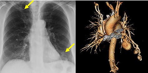 Chest radiograph and computed tomography volume rendered images of multiple aneurysmal PAVMs, including three in lingula and one in right upper lobe. Yellow arrows denote aneurysms.