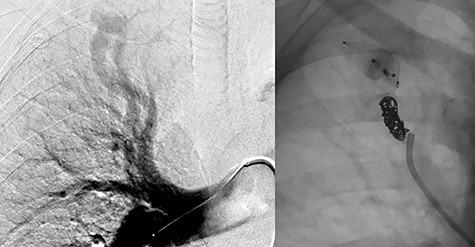 Embolization of right upper lobe PAVM with second and fourth generation Amplatzer™ Vascular Plugs and Nester® Embolization Coils.