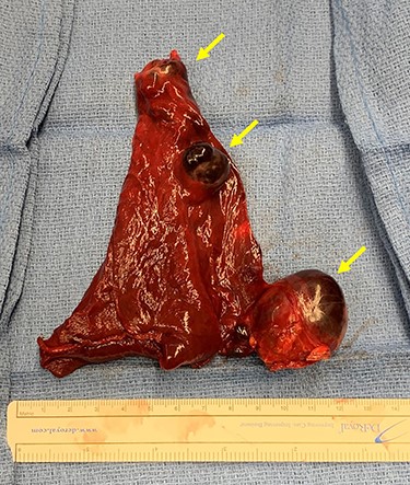 Lingulectomy specimen showing three sequential PAVMs off the inferior lingual artery subsegmental branches. Yellow arrows denote aneurysms.
