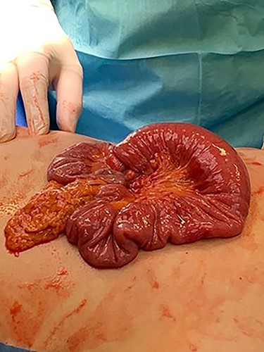 Small bowel intussusception causing small bowel obstruction.