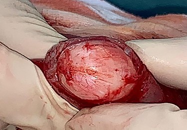Longitudinal enterotomy with demonstration of intraluminal lesion.