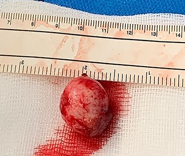 Resected intraluminal lesion.