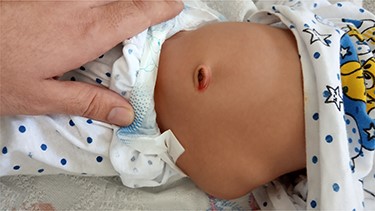 The CLH presenting as a bulge in the abdomen.