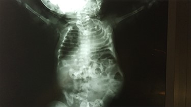 X-ray film shows absence of ribs and mild lumbar scoliosis.